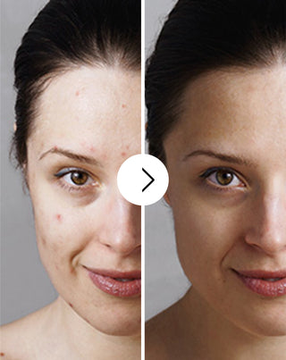 Tablete za akne, prištiće i nesavršenosti sa cinkom, vitaminom C, E i B2 Derminax - 6