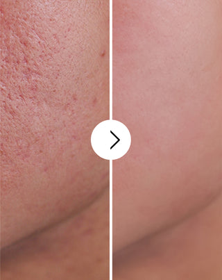 Tablete za akne, prištiće i nesavršenosti sa cinkom, vitaminom C, E i B2 Derminax_4 - 4