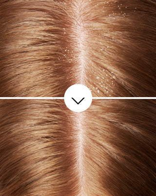 Nutridome šampon za kosu protiv peruti s pirokton olaminom s hidratantnim učinkom - 5