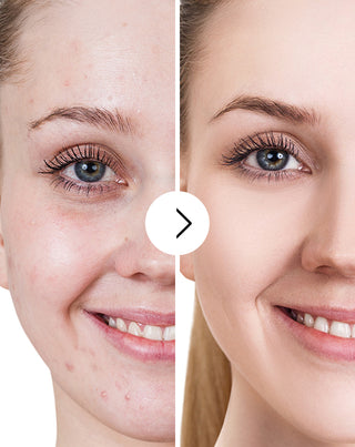 Tablete za akne, prištiće i nesavršenosti sa cinkom, vitaminom C, E i B2 Derminax_5 - 5