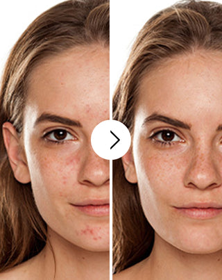 Tablete za akne, prištiće i nesavršenosti sa cinkom, vitaminom C, E i B2 Derminax_2 - 2