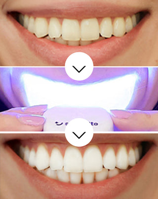 Set za izbjeljivanje zubi s LED svjetiljkom i gelom za izbjeljivanje Light & Bright Smilebite - 3